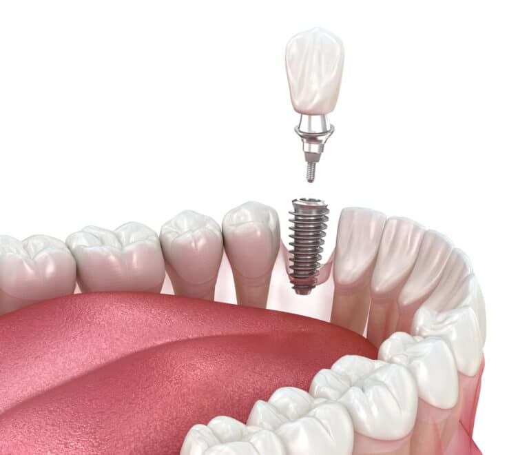 Dental Implants Payment Plans And Financing Options Explained