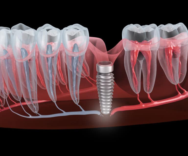 When Are Dental Implants Medically Necessary?