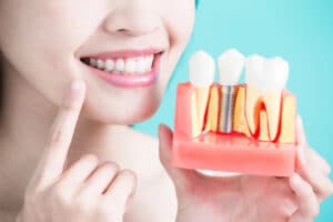 How Long Do Dental Implants Last? Lifespan Factors And Tips