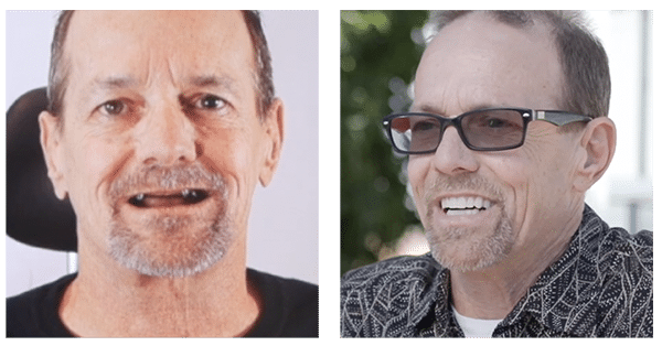 Comparison image of Dental Implants GPS patient