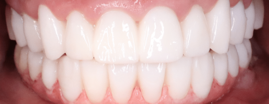 Close-up of a patient's natural-looking full-arch dental implant smile result