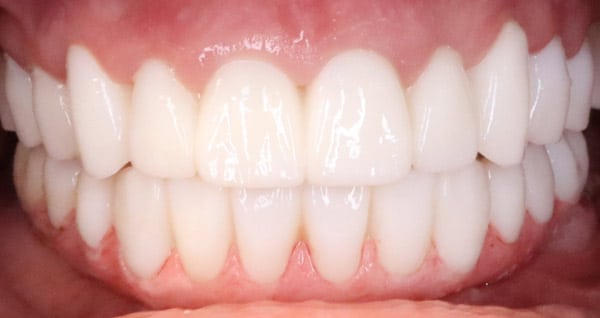 Photo showing smile with GPS Implant Bridge Maximum Bone Protection