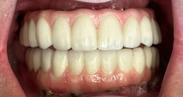 Photo of implants from a National Chain Implant Denture, showing Significant Bone Removal