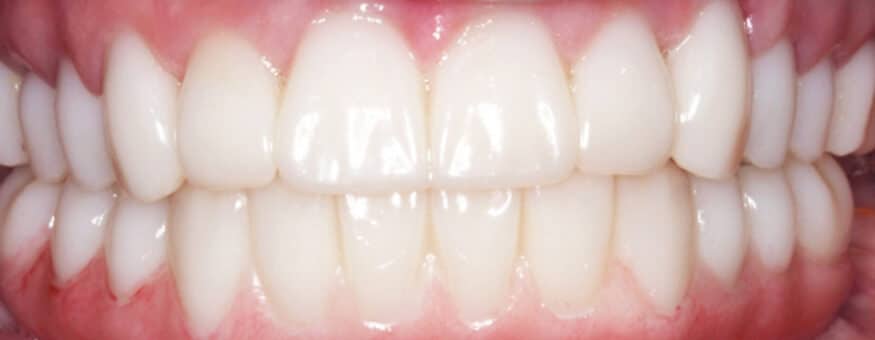 Close-up of a patient's natural-looking full-arch dental implant smile result