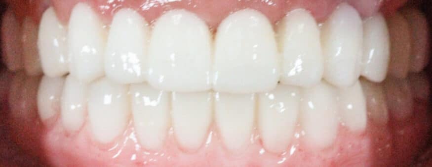 Close-up of a patient's natural-looking full-arch dental implant smile result
