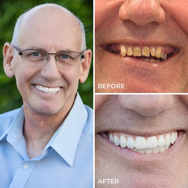Mark - Before and After