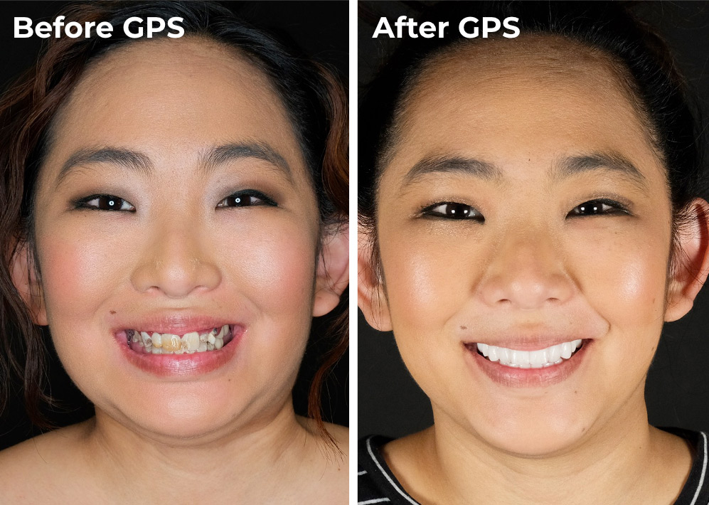 Image showing comparison for a Dental Implants GPS patient