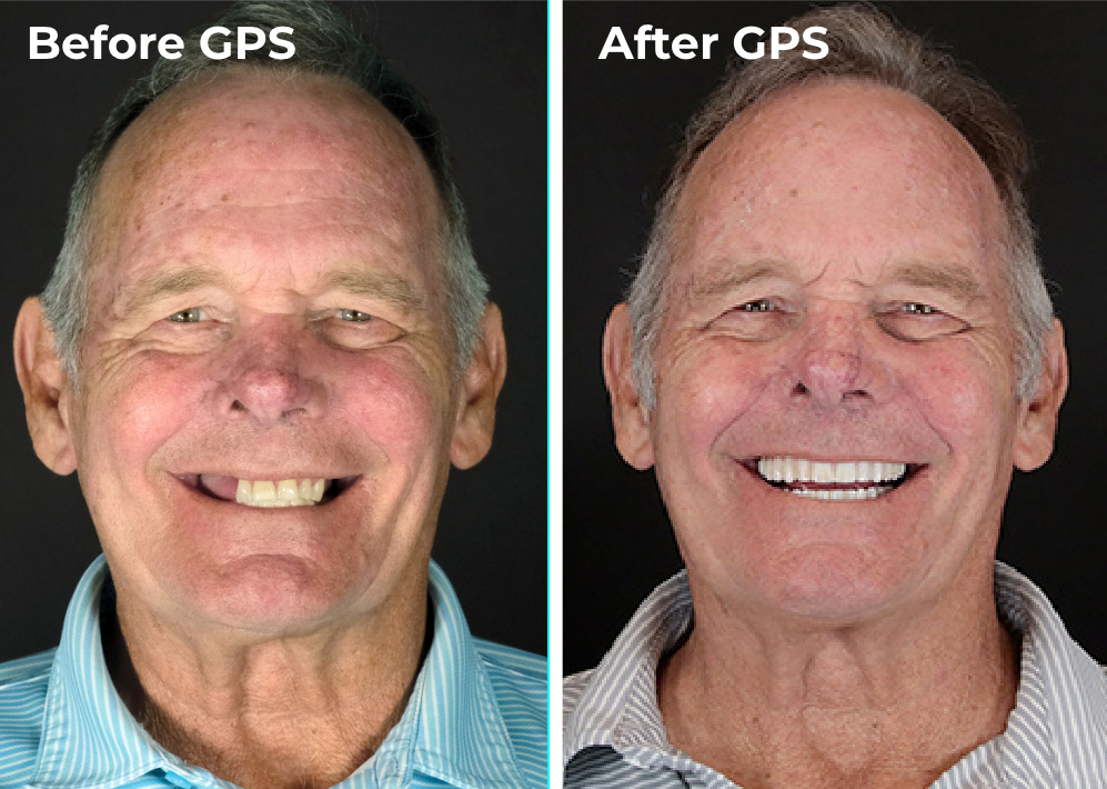 Image showing comparison for a Dental Implants GPS patient