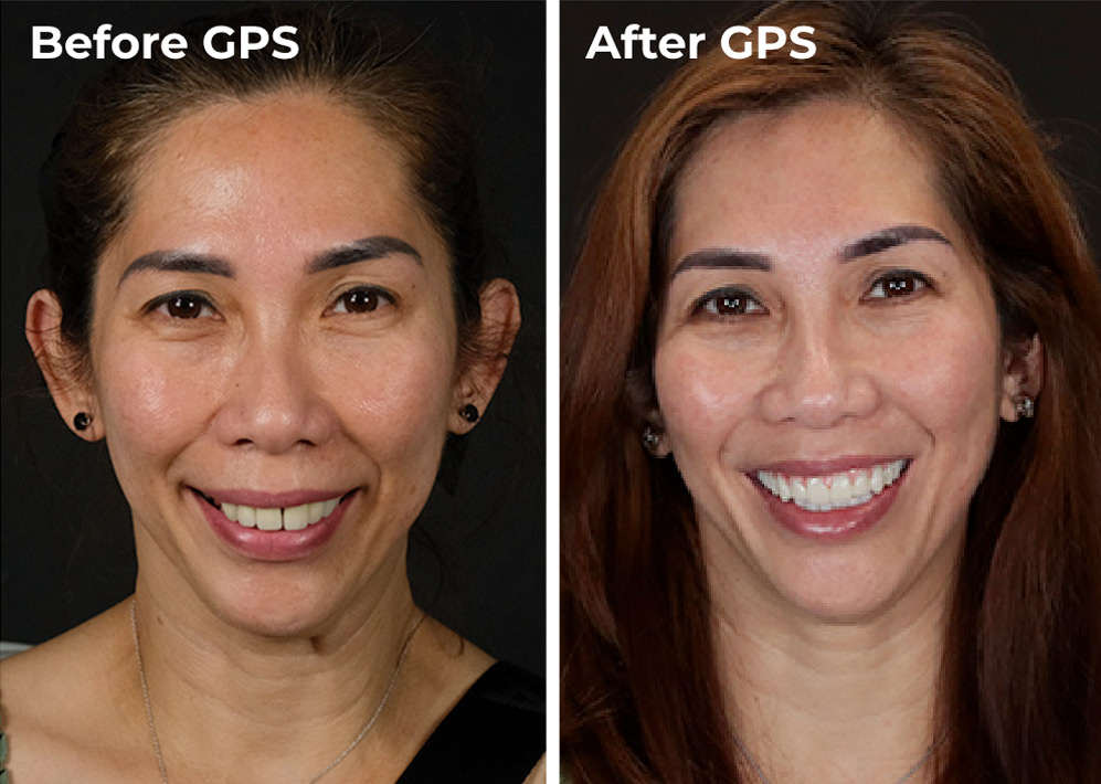 Image showing comparison for a Dental Implants GPS patient