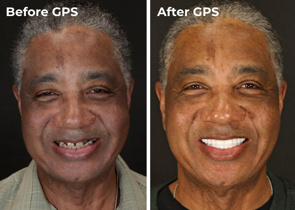 Image showing comparison for a Dental Implants GPS patient