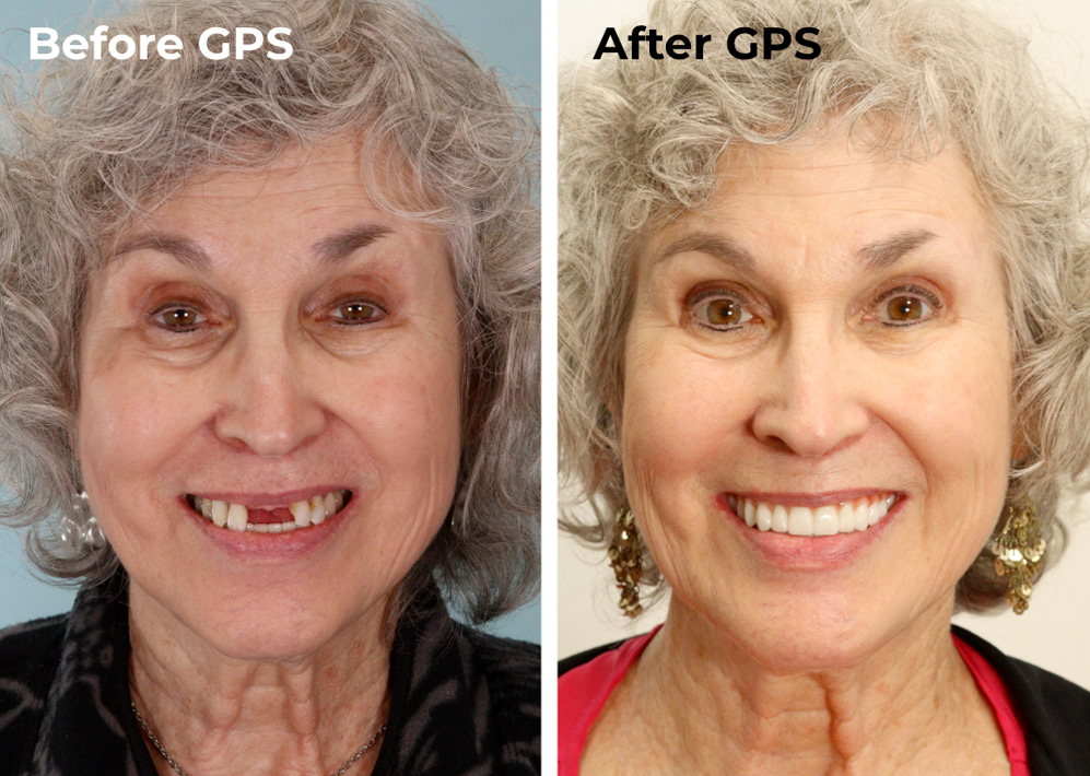 Image showing comparison for a Dental Implants GPS patient