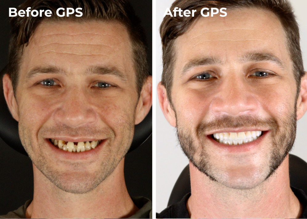 Image showing comparison for a Dental Implants GPS patient